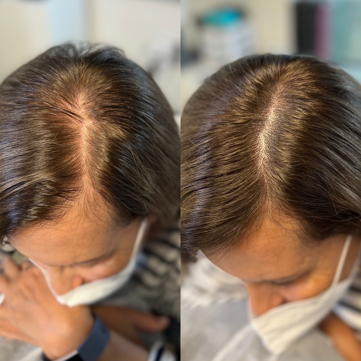 Thinning Dry Lifeless Hair